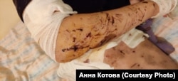Тіло Анни посічене уламками